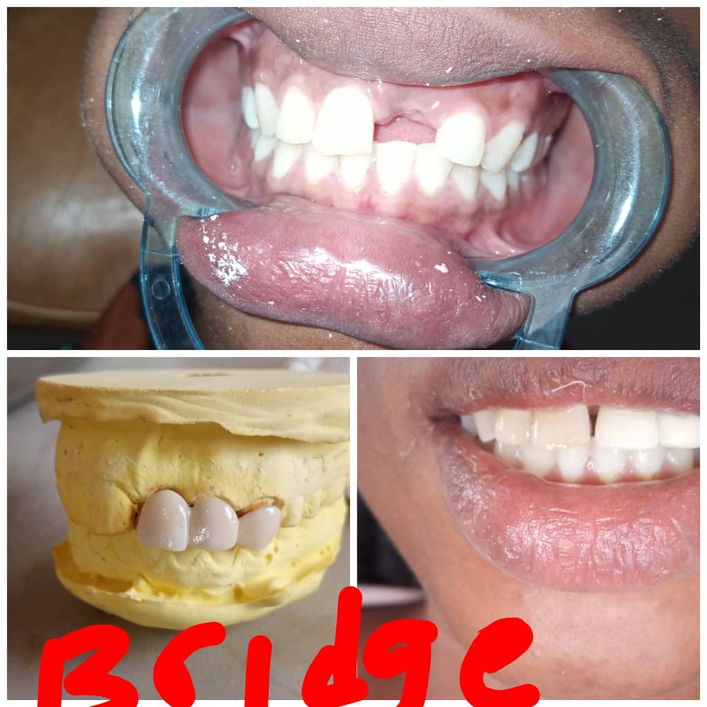 Conservative Dentistry-cantilever bridge