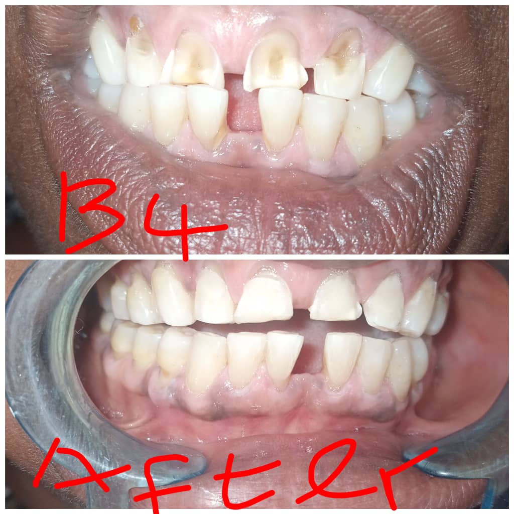 Conservative dentistry-direct composite veneers