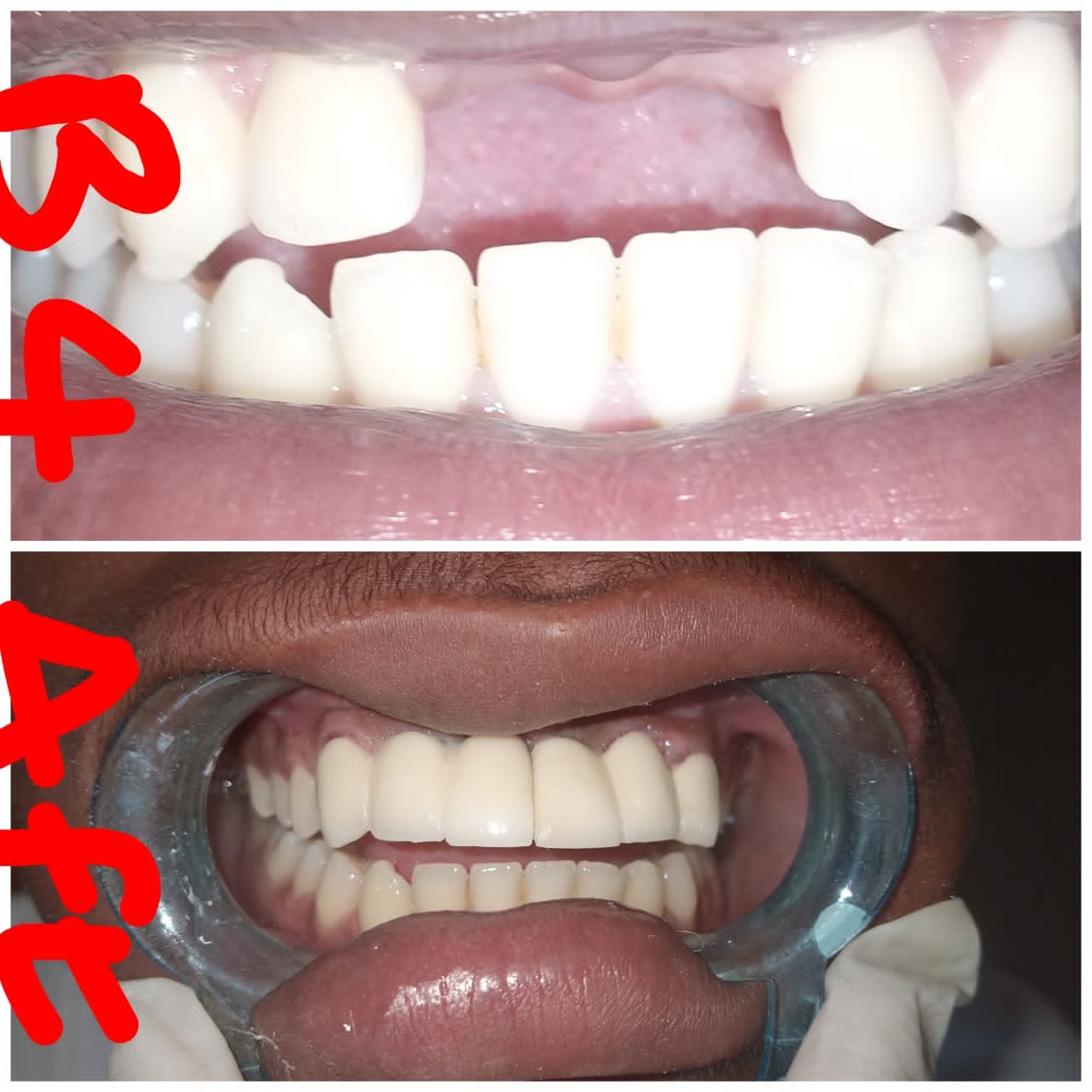 Restorative Dentistry-porcelian fused to metal bridge