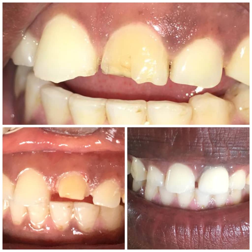 conservative Dentistry-porcelain fused of metal brown