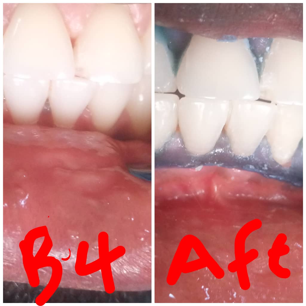 Aesthetics Dentistry-Teeth Whitening