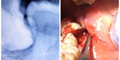 maxilofacial surgery on third molar